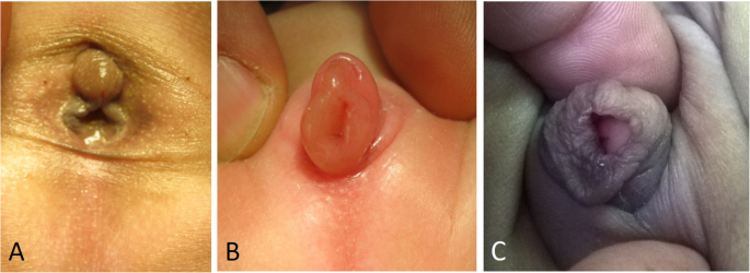 Cloacal Malformation